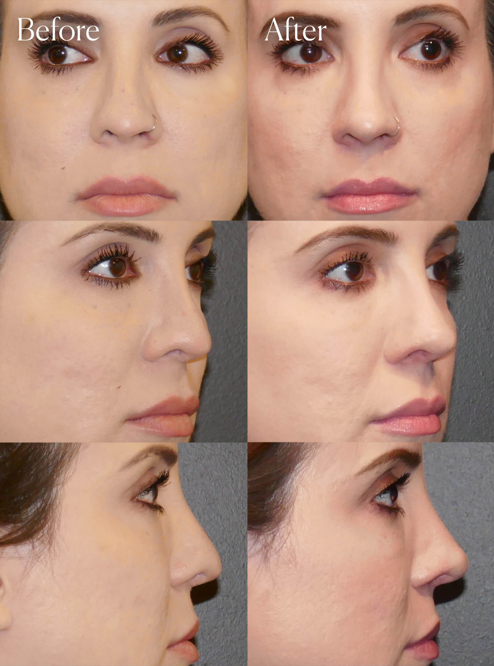 revision rhinoplasty plastic surgery