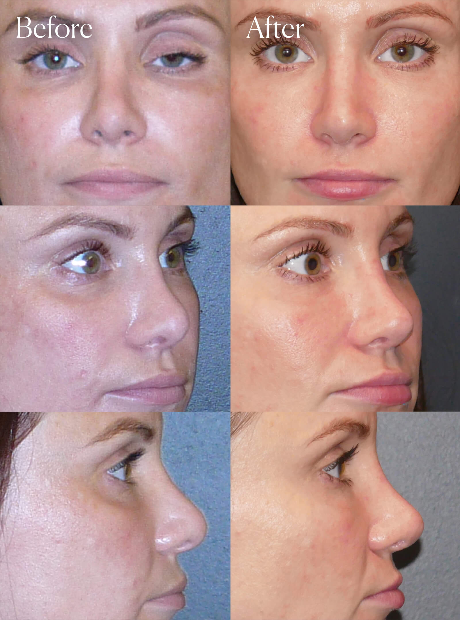 revision rhinoplasty procedure colorado