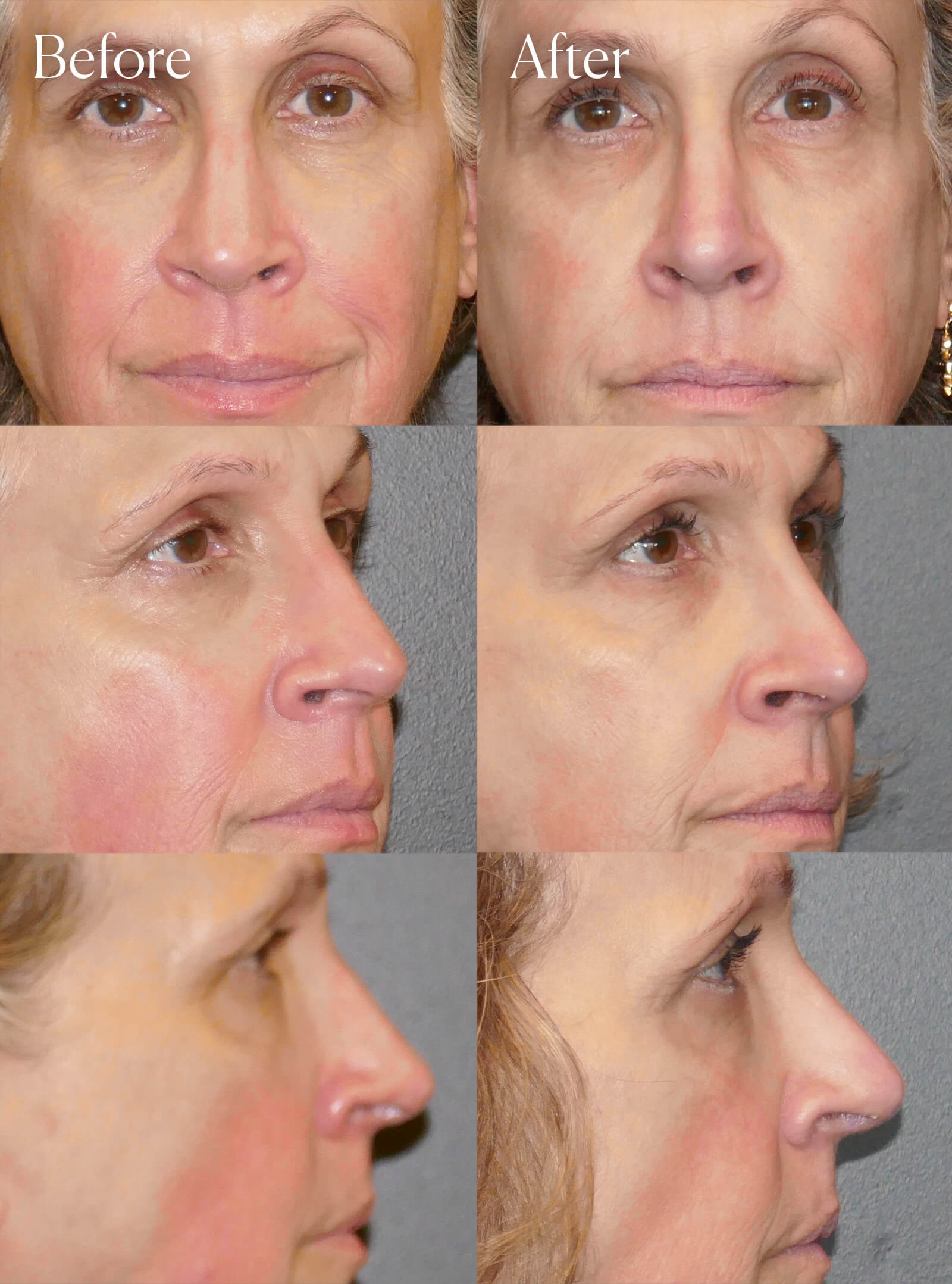 revision rhinoplasty surgery enhancements