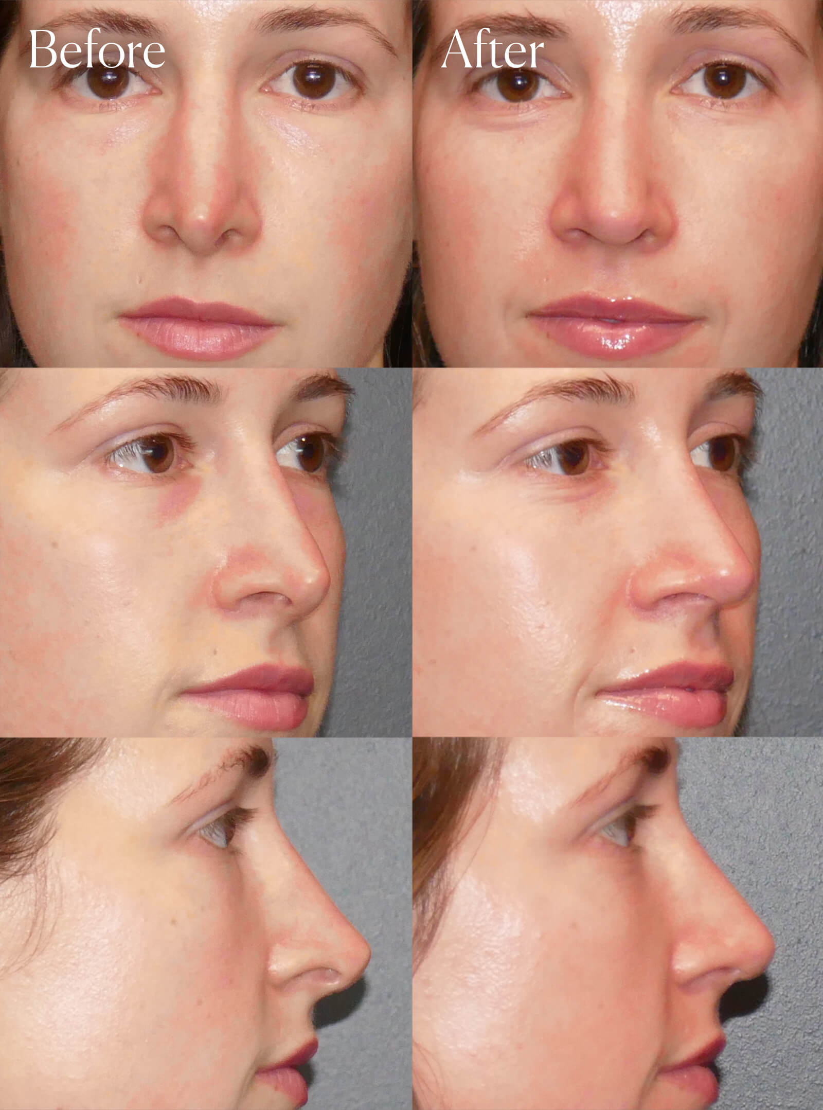 revision ultrasonic rhinoplasty plastic surgery