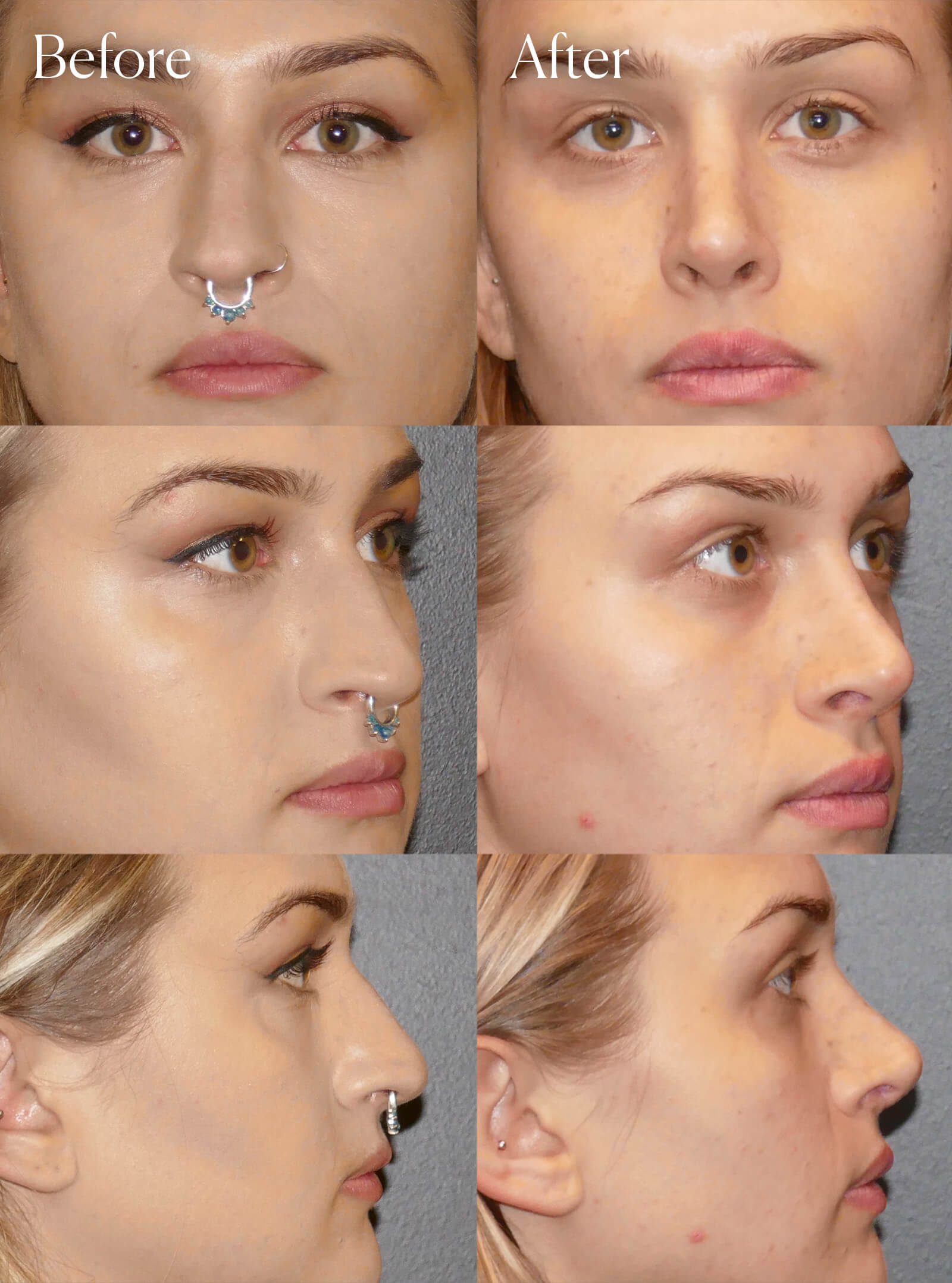 rhinoplasty aesthetic surgery