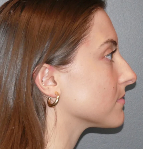 rhinoplasty before