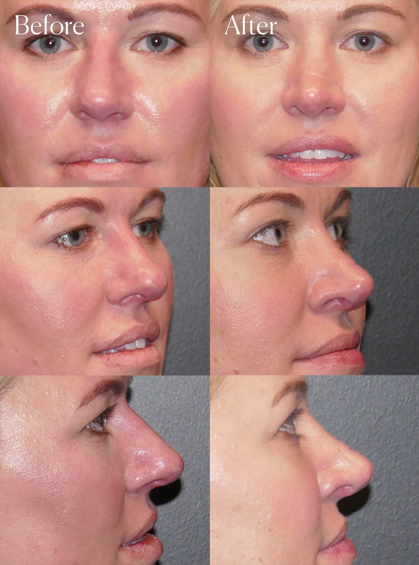 rhinoplasty surgery results