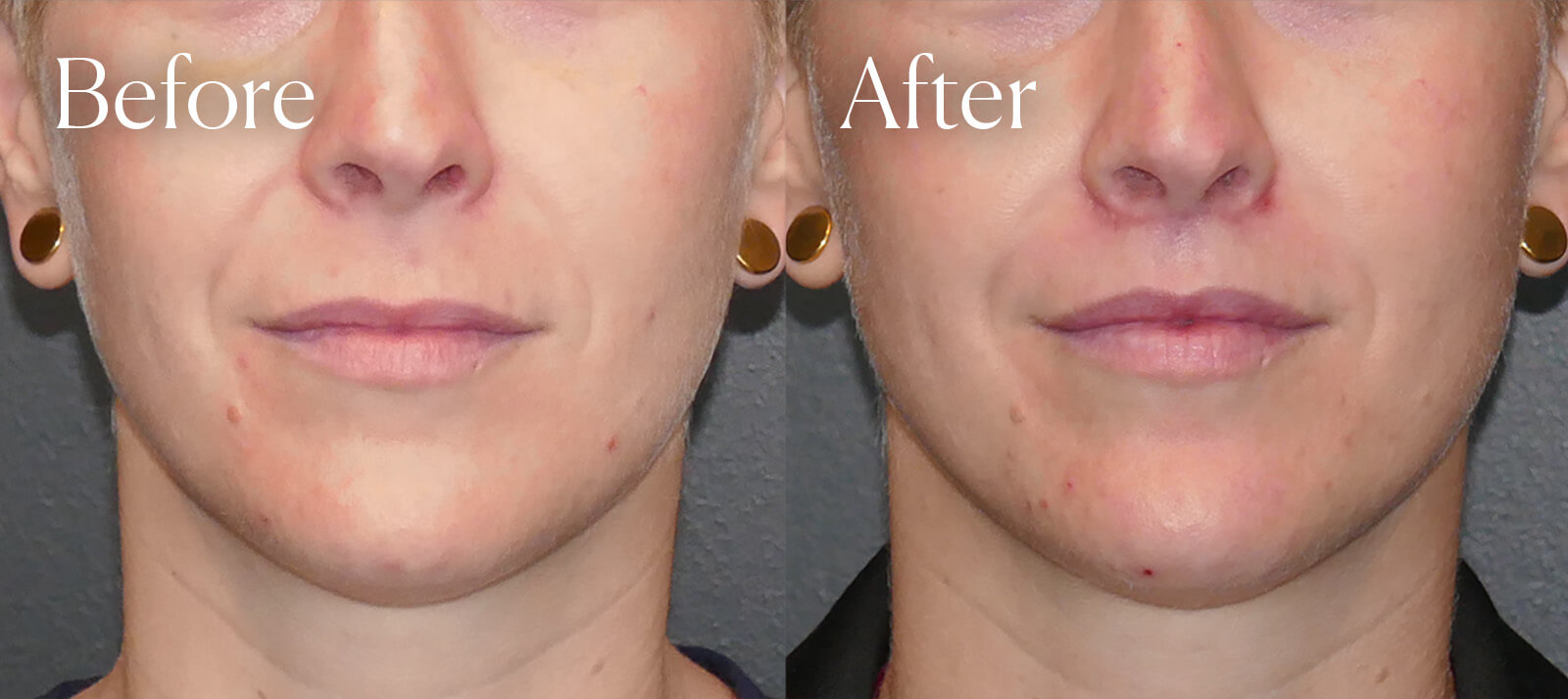 subnasal liplift before and after