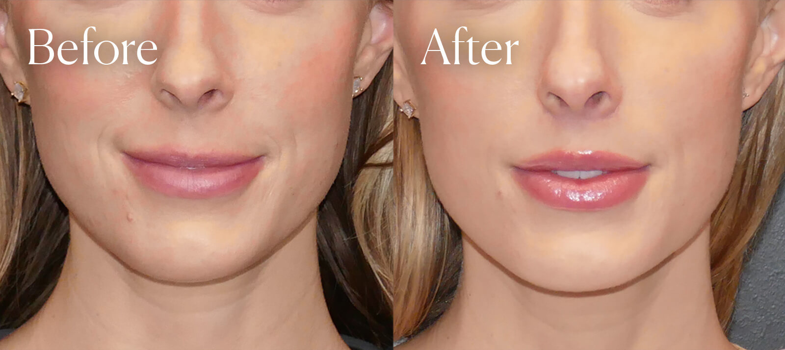 subnasal liplift facial enhancements