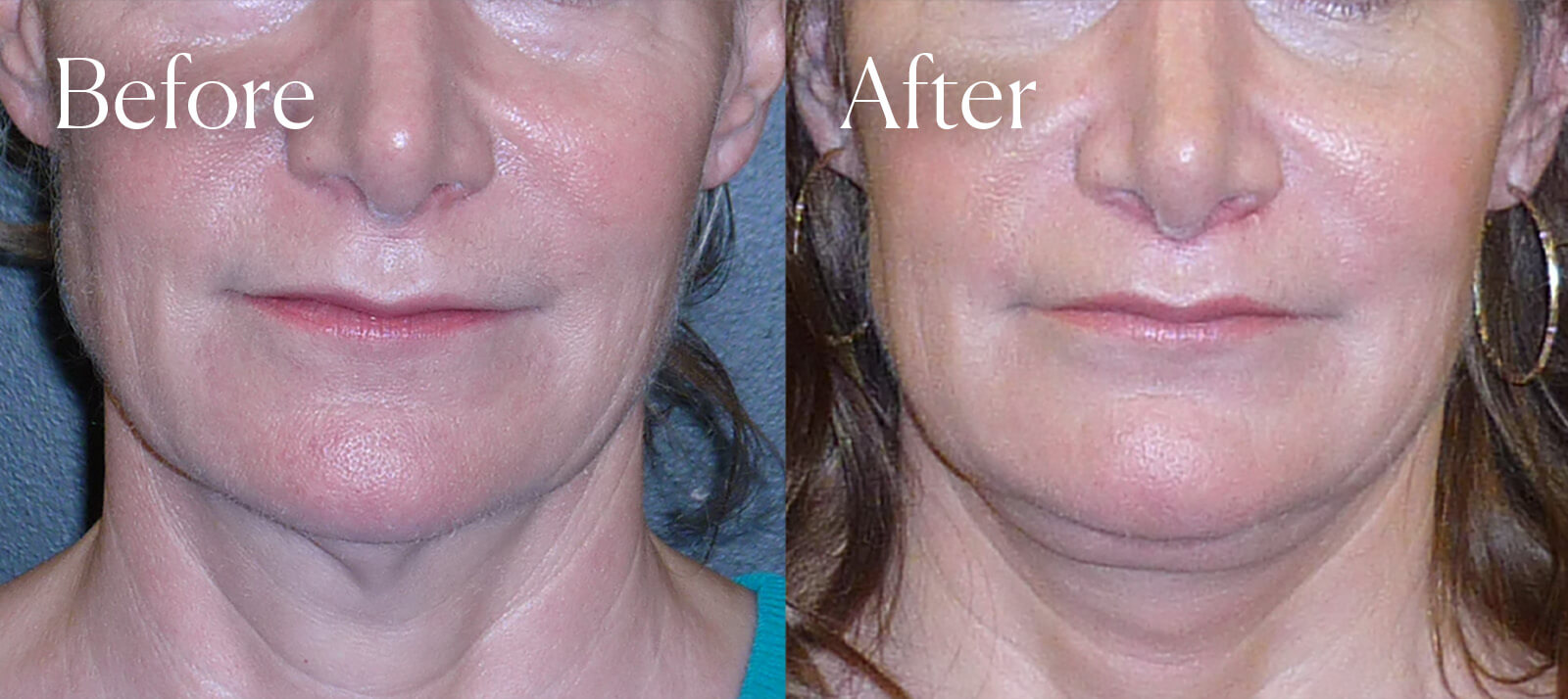 subnasal liplift facial surgery