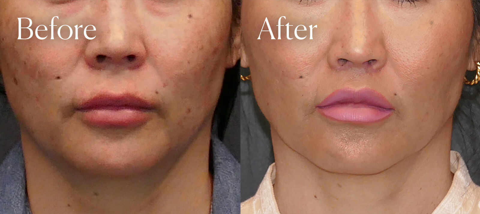 subnasal liplift surgery results