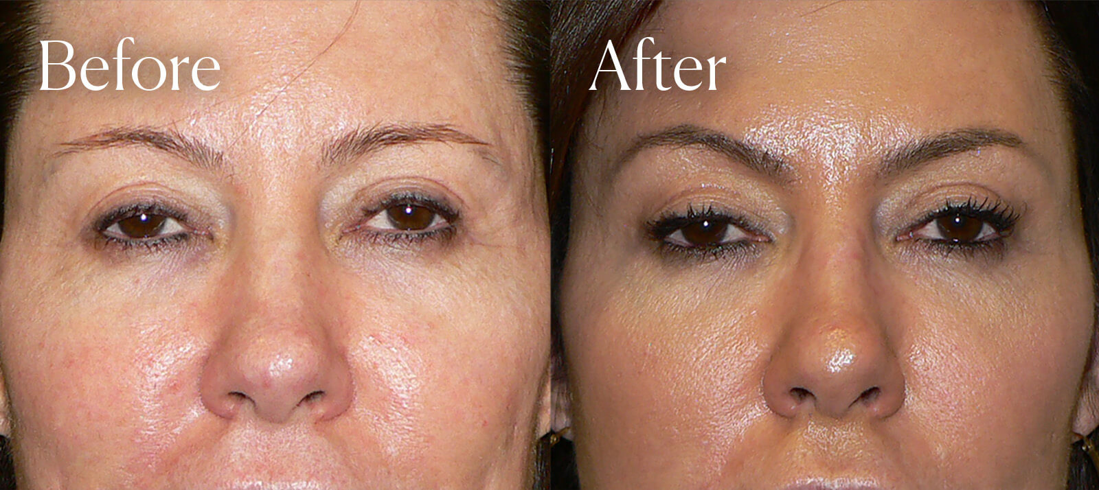 temporal browlift facial enhancements