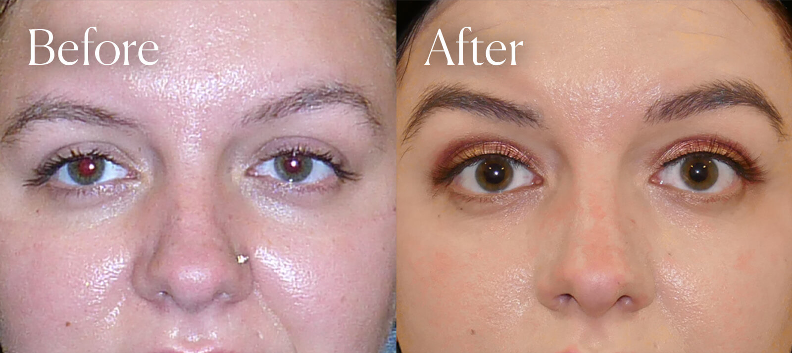 temporal browlift facial procedure