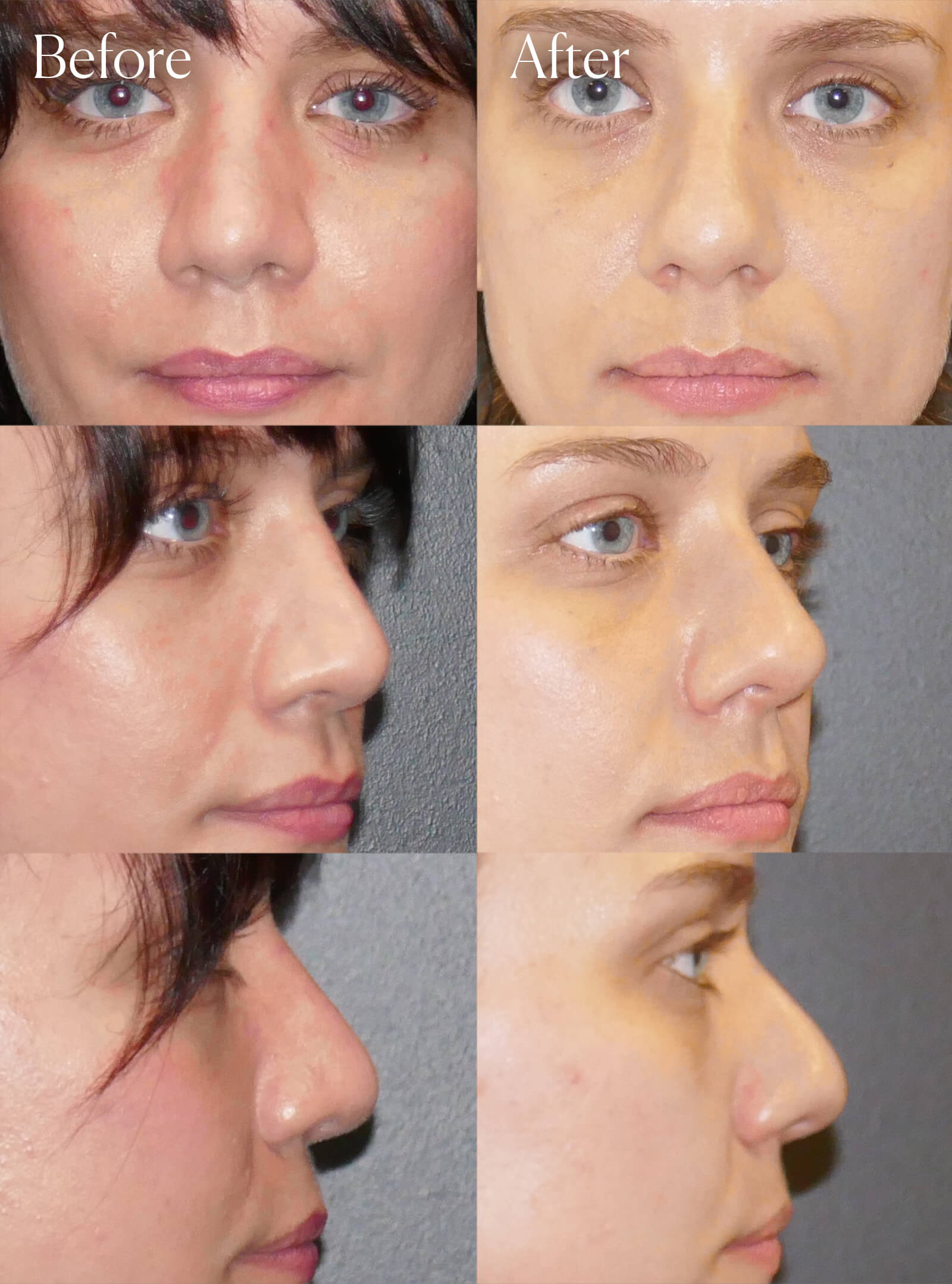 tip rhinoplasty mini facelift