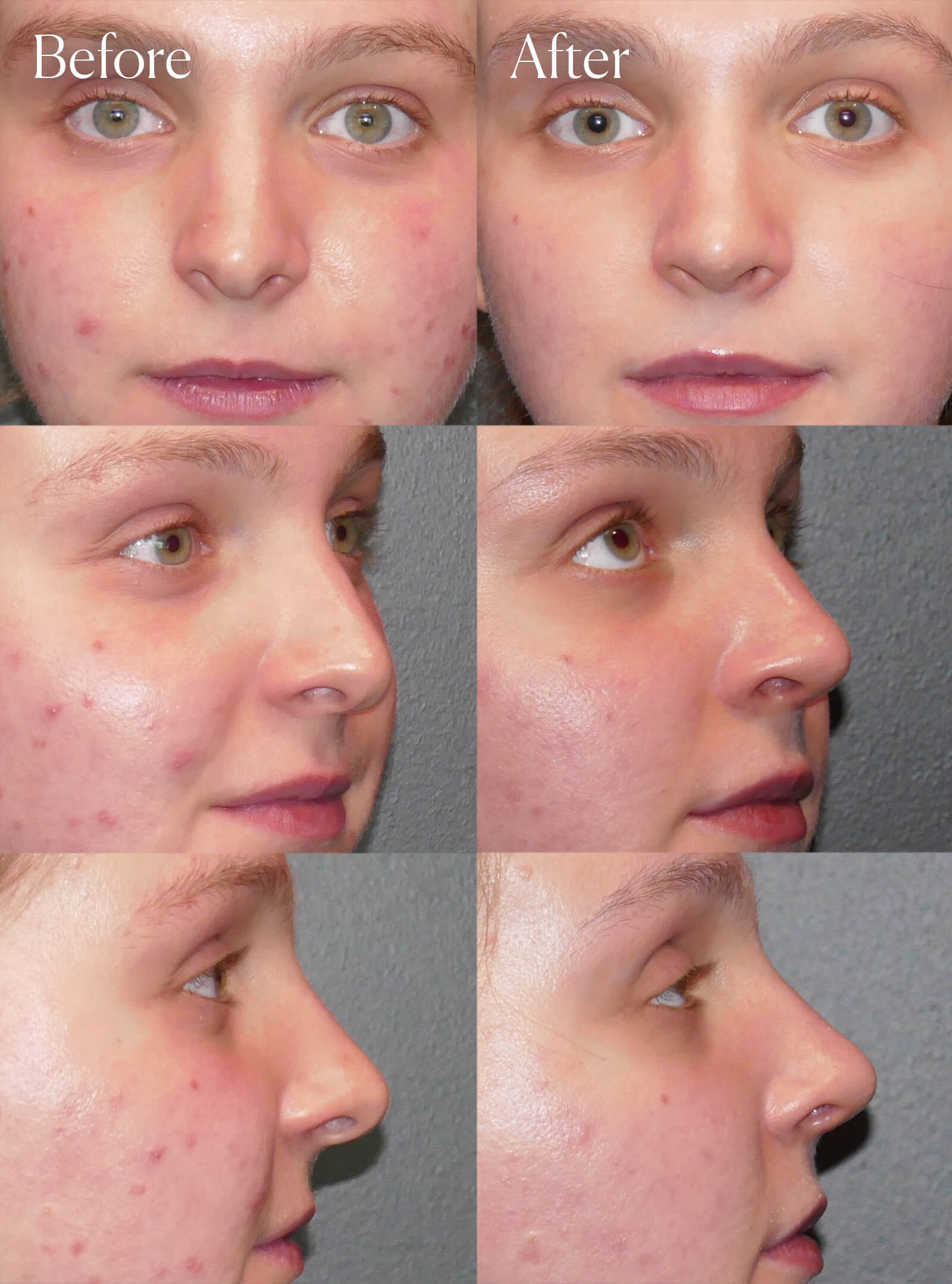 tip rhinoplasty procedure colorado