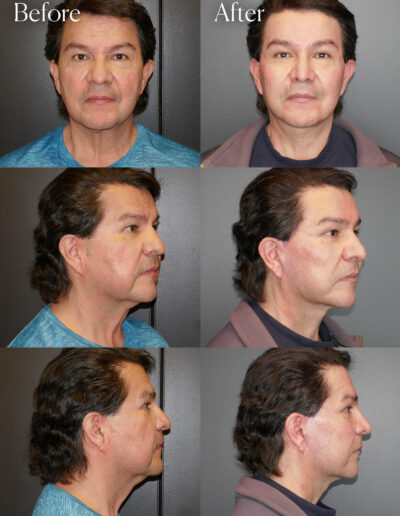 ultralift facelift necklift before and after