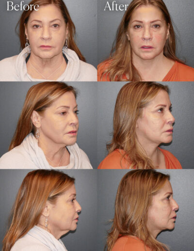 ultralift facelift surgery results