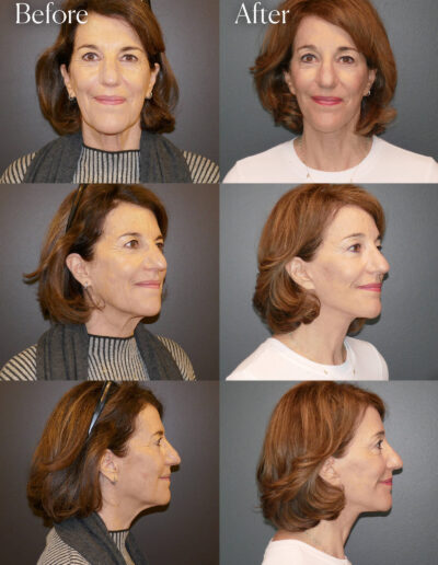 ultralift facial procedure