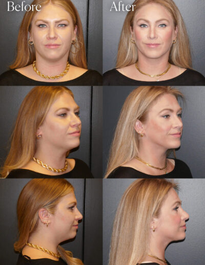 ultralift necklift chin implant browlift rhinoplasty