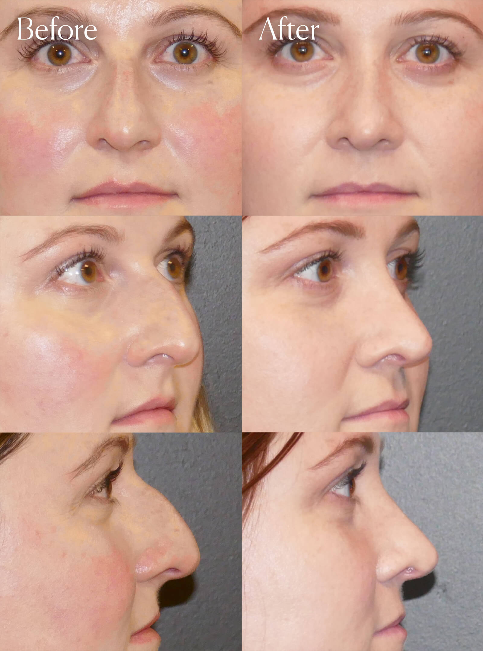 ultrasonic rhinoplasty before and after