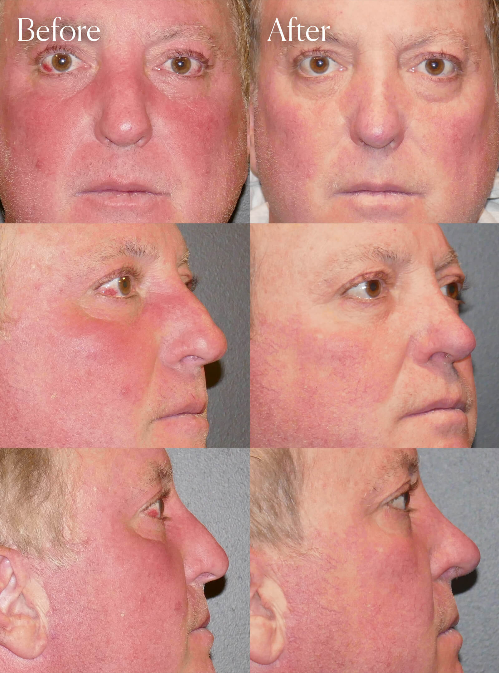 ultrasonic rhinoplasty plastic surgery