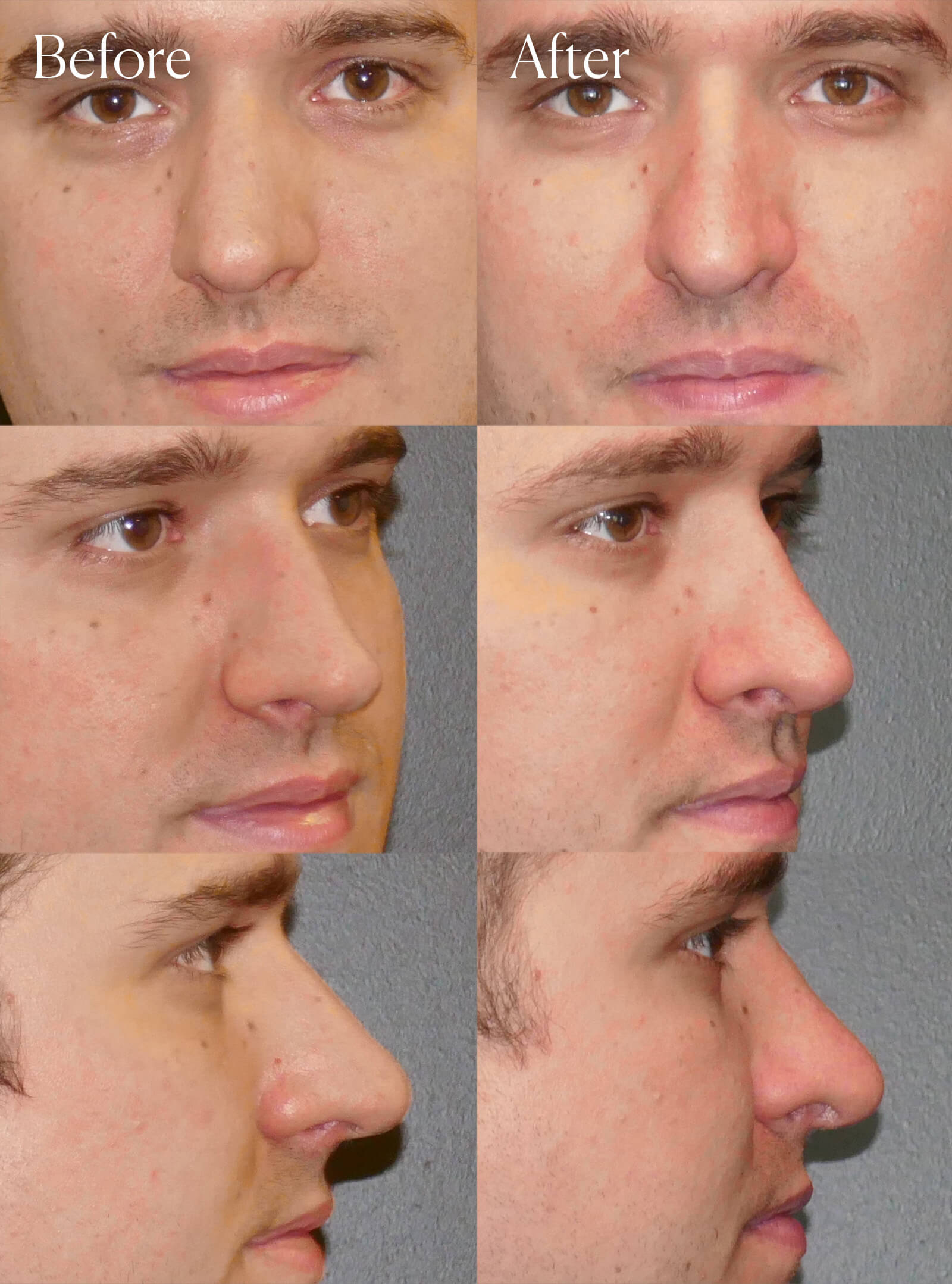 ultrasonic rhinoplasty procedure colorado