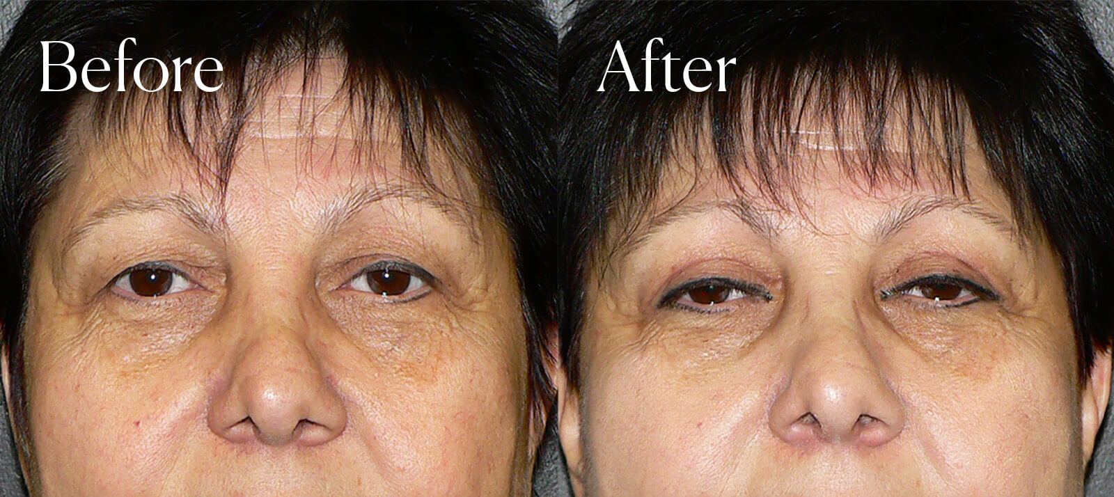 upper blepharoplasty aesthetic surgery