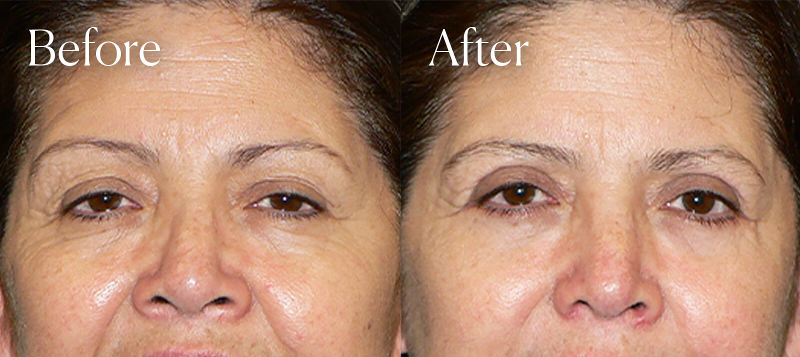 upper blepharoplasty plastic surgery