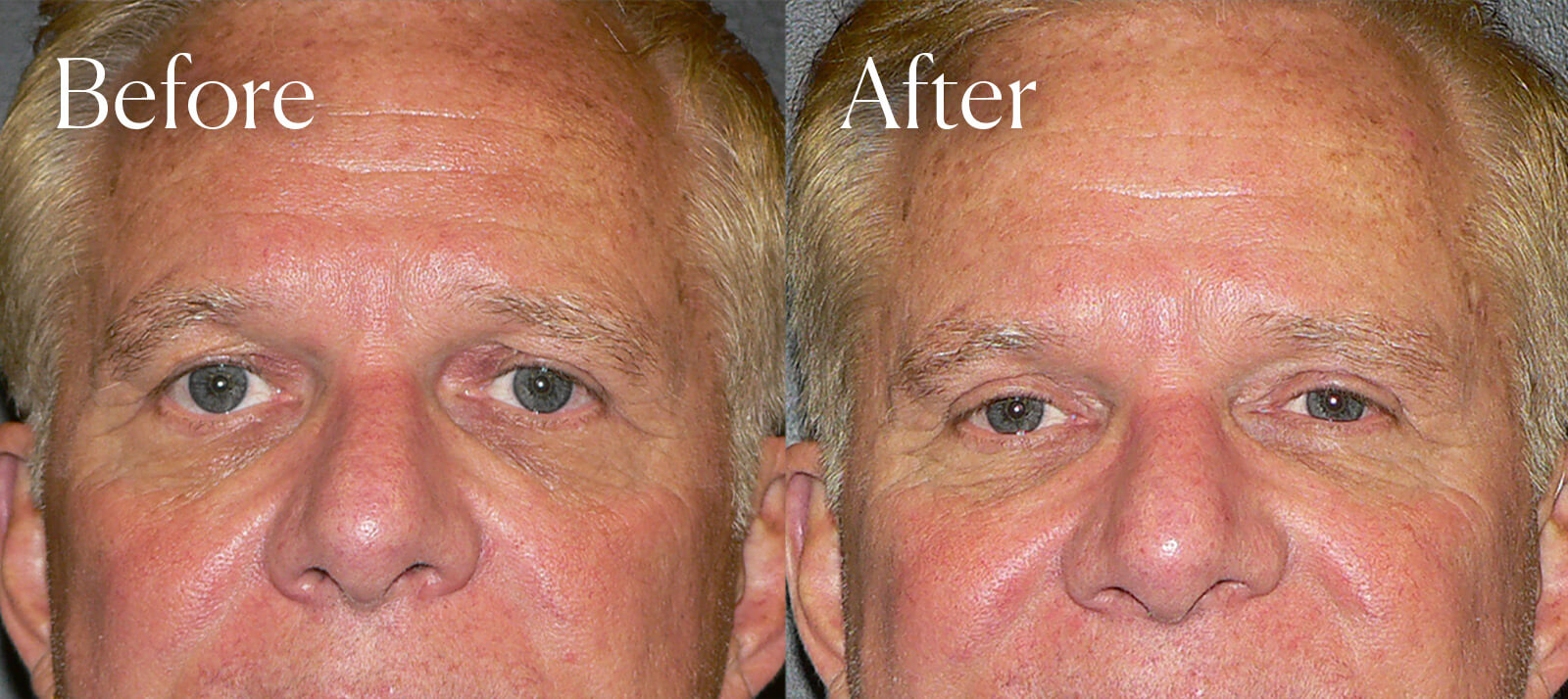 upper blepharoplasty procedure