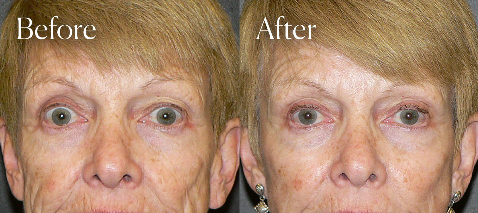 upper blepharoplasty surgery enhancements